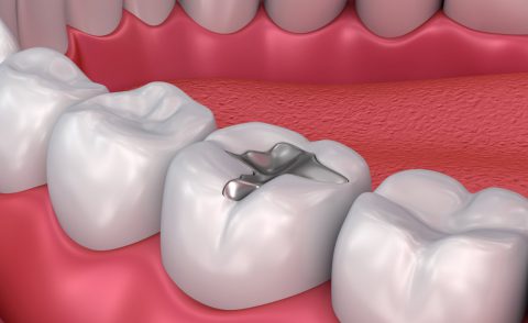 filling-480x294