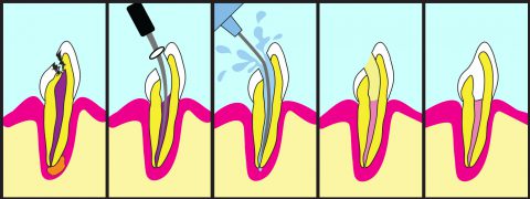 RootCanal_Illustration-480x180